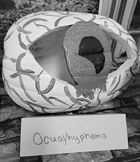 SHS Pumpkin-ology Contest Winner- Ocular Hyphema by Molli McCoy. Photo courtesy of Silsbee ISD.